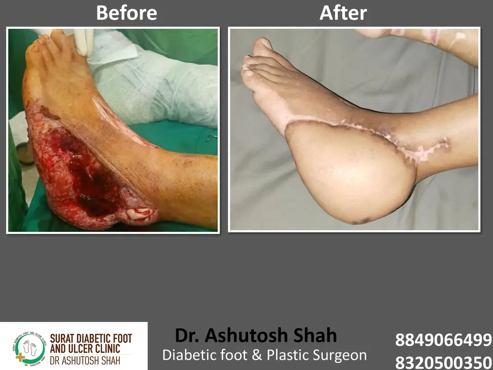 Diabetic Foot  PPT sunita.pptx-14.webp